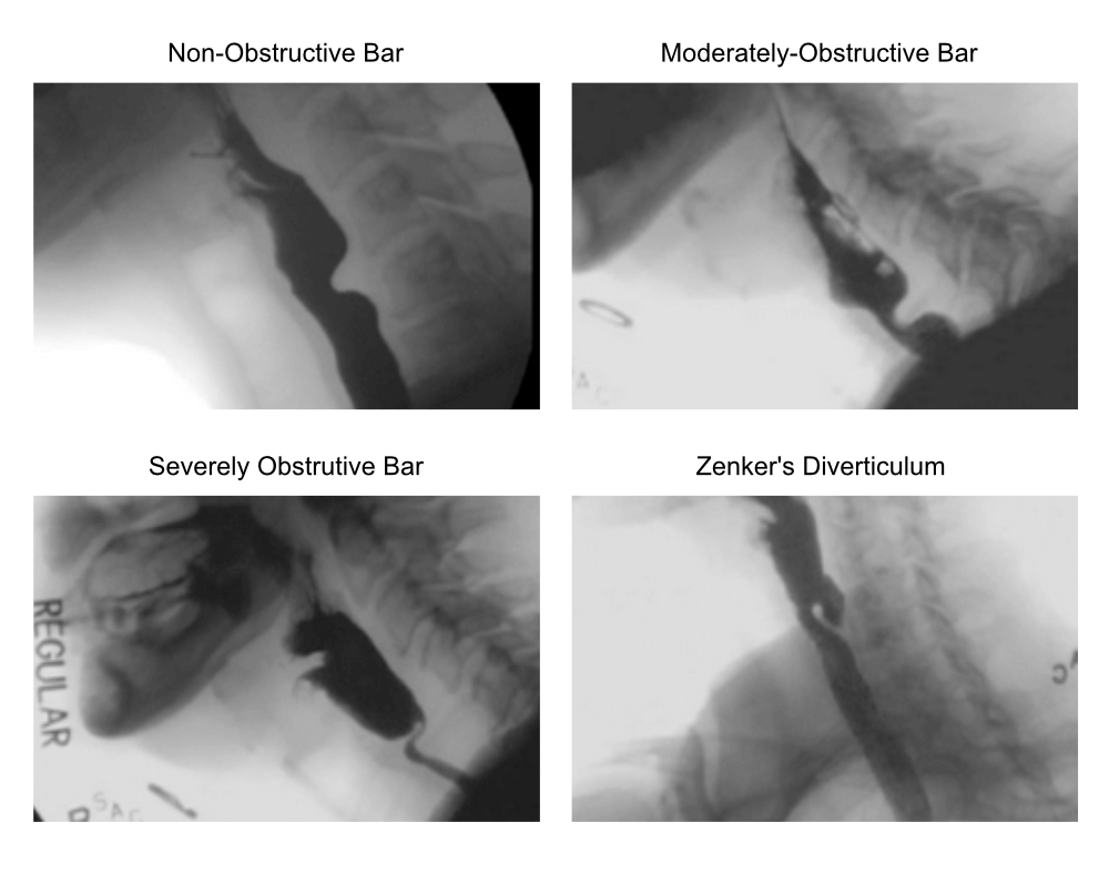 Is zenker diverticulum 2025 congenital